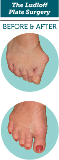 bunion bunion